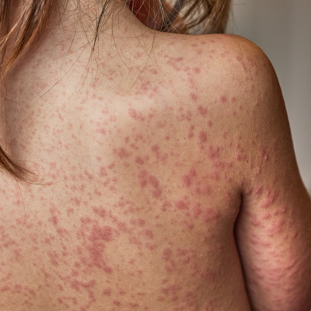 A female with psoriasis on her back.